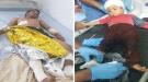 انفجار مقذوف من مخلفات الحوثي في 3 أطفال شمال الضالع  ...